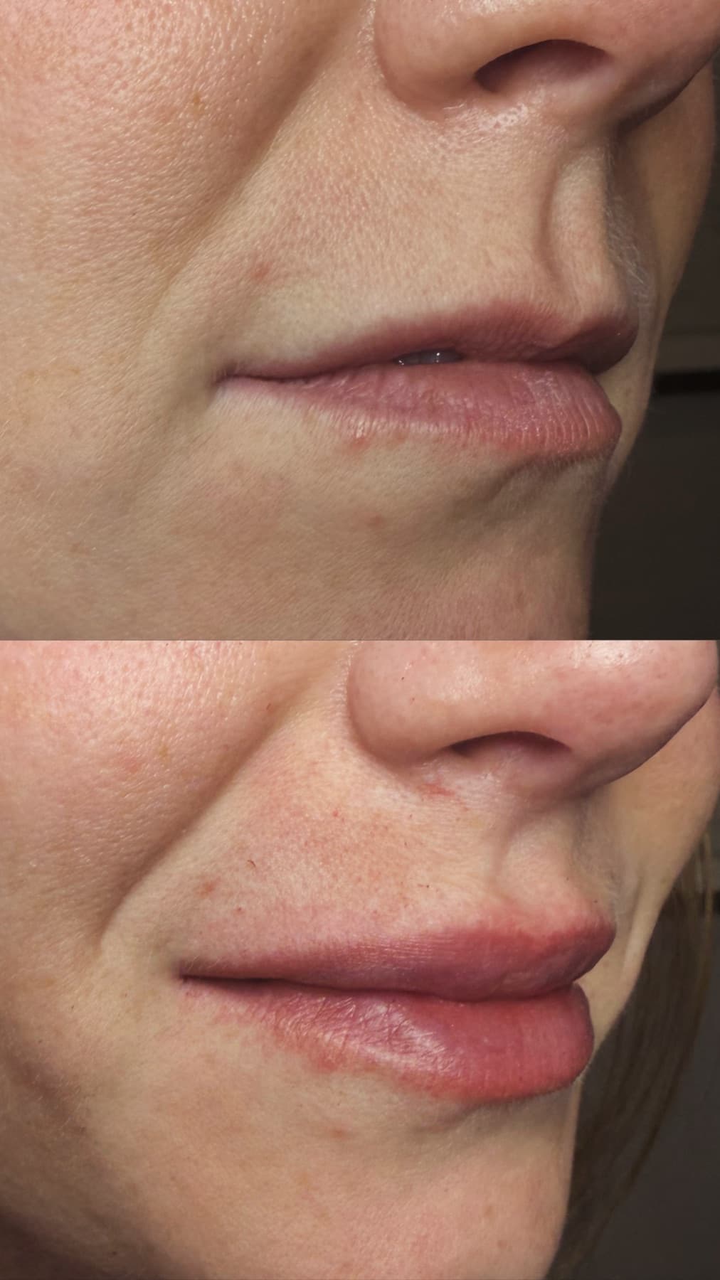 Before and after a lip booster treatment by Hunny, showing fuller and better defined lips